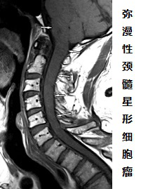 脊髓<a href='/jibing/naojiaozhiliu/1548.html' target='_blank'><u>胶质瘤治疗</u></a>方法