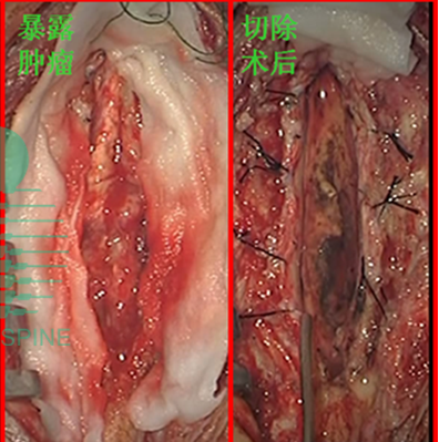 脊髓胶质瘤治疗新方法