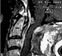 枕骨大孔区脑膜瘤手术成功率高吗？