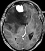 胶质瘤与脑膜瘤并发，脑部胶质瘤病因为何？
