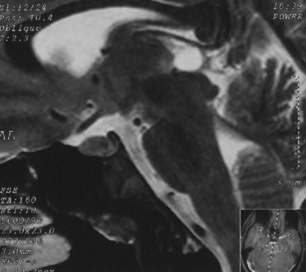 松果体囊肿患者的癫痫发作机制有何不同？