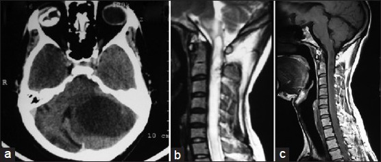 颈髓胶质瘤案例