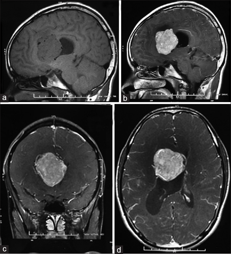 胶质母细胞瘤被“误诊”为脑膜瘤，他的脑胶质瘤能治好吗？