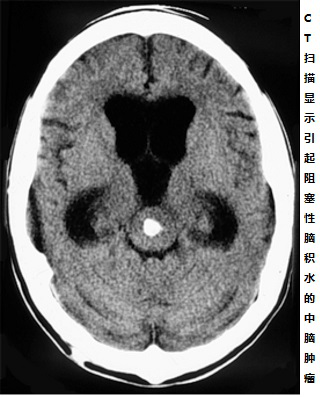 胶质瘤保守治疗