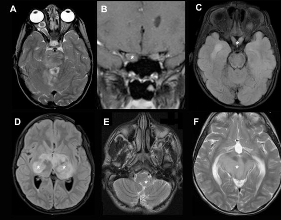 视神经胶质瘤能治好吗？1型神经纤维瘤病中的视神经胶质瘤严重吗？
