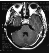 面部麻痹、耳鸣竟是岩斜区脑膜瘤，顺利全切好转生活