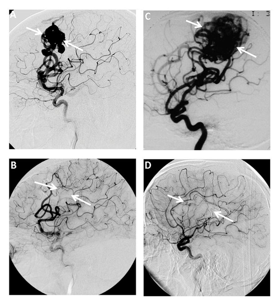 脑干动静脉畸形的切除与原位闭塞