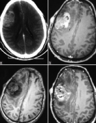 神经纤维瘤患者得脑瘤的概率高吗？神经胶质瘤预后如何