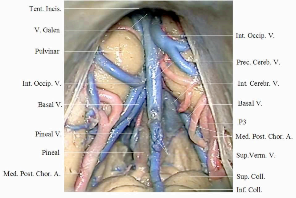 INC国际专家采用幕下小脑上入路成功切除松果体区肿瘤