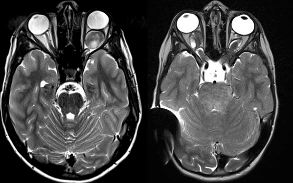 视神经胶质瘤的当前治疗方法