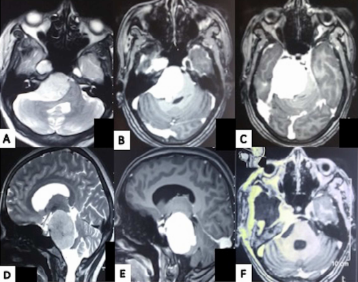 年轻白领每天无故发笑，就医发现竟患上岩斜区脑膜瘤