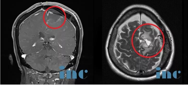 大脑镰帝脑膜瘤案例