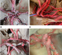 前交通动脉瘤显微外科手术策略