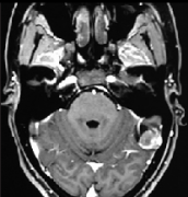 18岁少女深受“打哈欠”困扰，病因竟是脑部胶质瘤