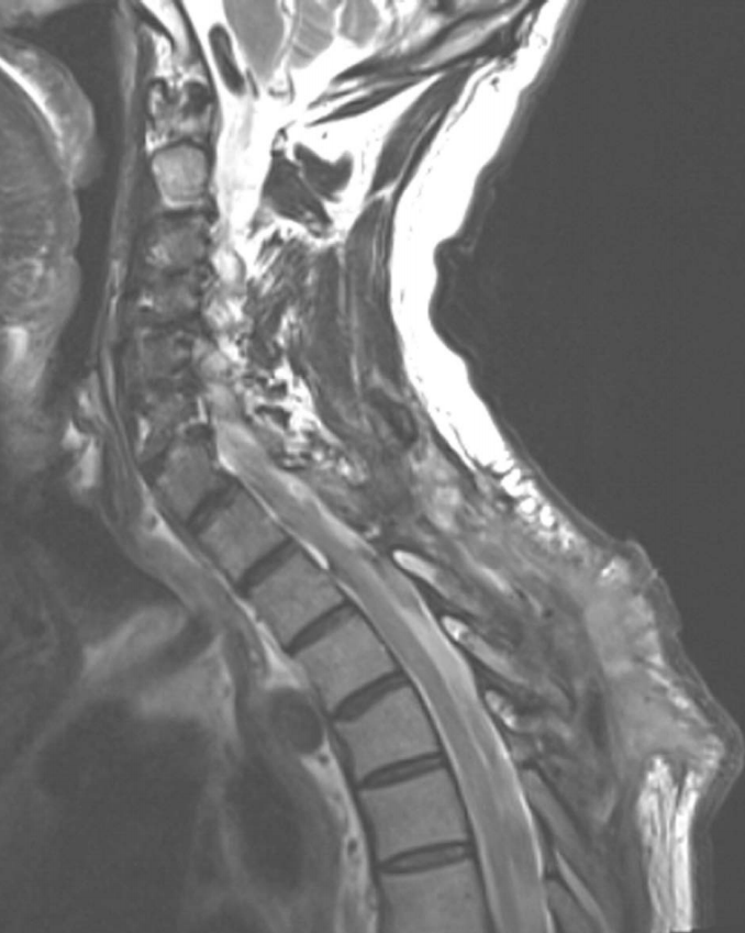科学探讨：如何定义和诊断脊髓空洞症？