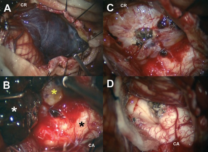恶性室管膜瘤图片