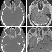 斜坡和岩斜区脊索瘤不建议手术吗？