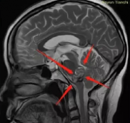 易出血、复发的海绵状⾎管瘤手术技术及疑难案例解析