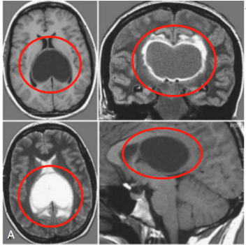 腦瘤案例圖片