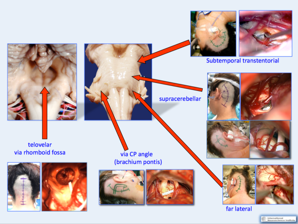 神经系统海绵状血管瘤的外科治疗，手术还是保守？