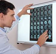 视路胶质瘤能治好吗？