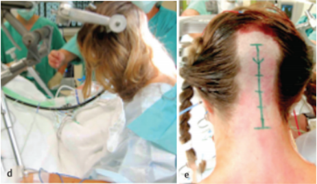 脑干胶质瘤手术案例