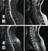 脊髓髓内肿瘤都是恶性的吗？