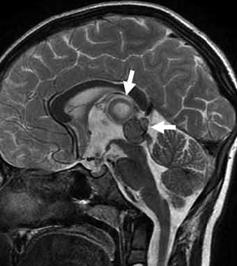 松果体区肿瘤组织学诊断：活检还是开颅切除