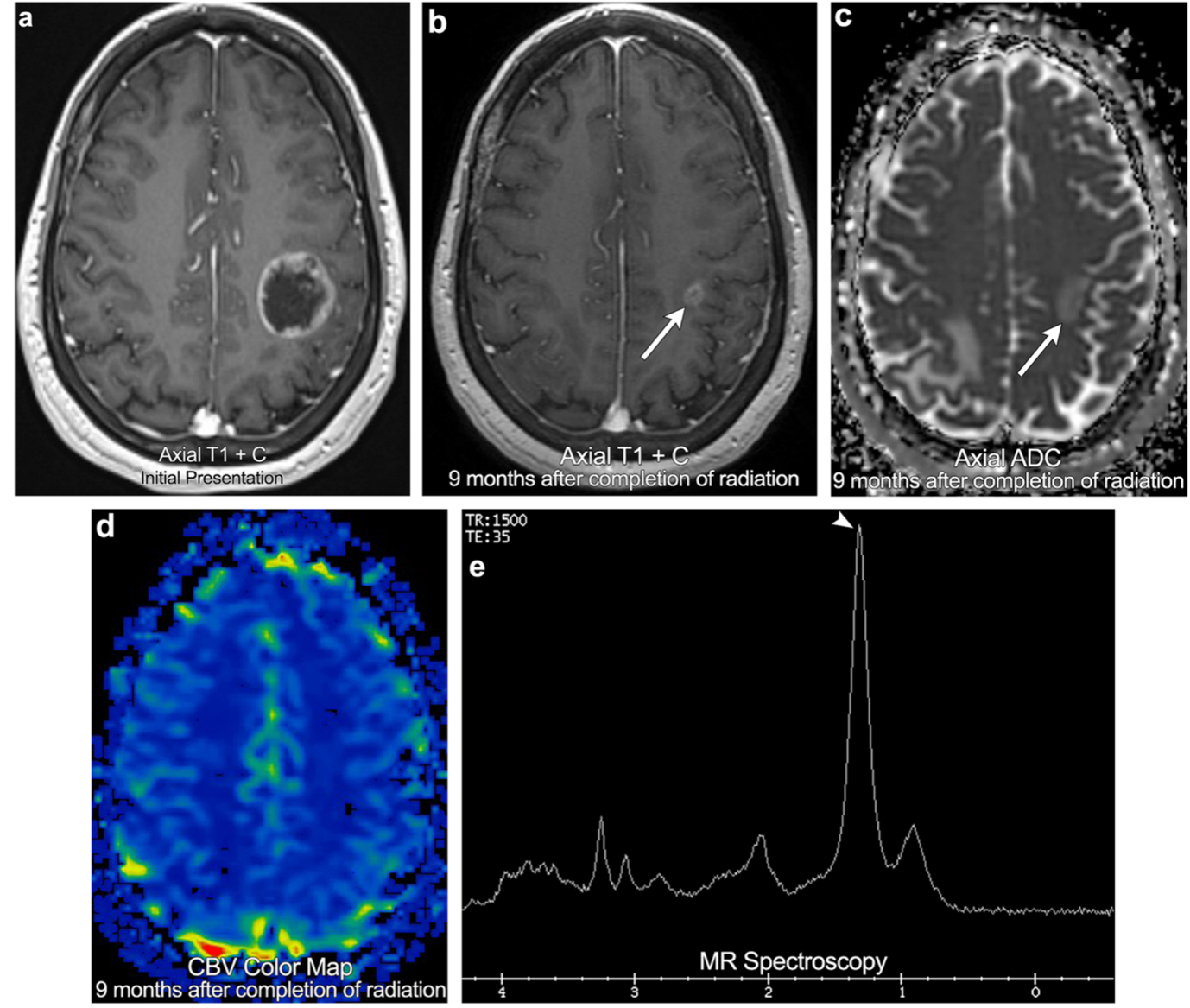 高级别胶质瘤与脑转移瘤的治疗反应标准