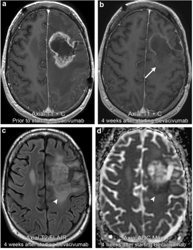 左额叶星形细胞瘤