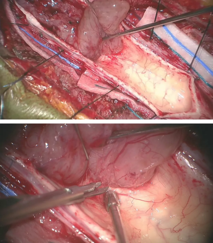 脊髓髓内肿瘤手术