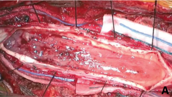 脊髓髓内肿瘤手术