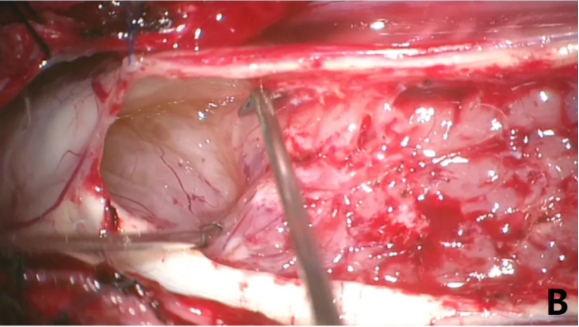 脊髓髓内肿瘤手术