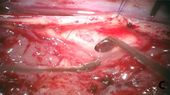 脊髓髓内肿瘤手术