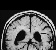 脑海绵状血管瘤无症状或者偶然发现，需要手术吗？