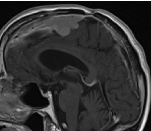 恶性脑膜瘤预后好吗？如何治疗？