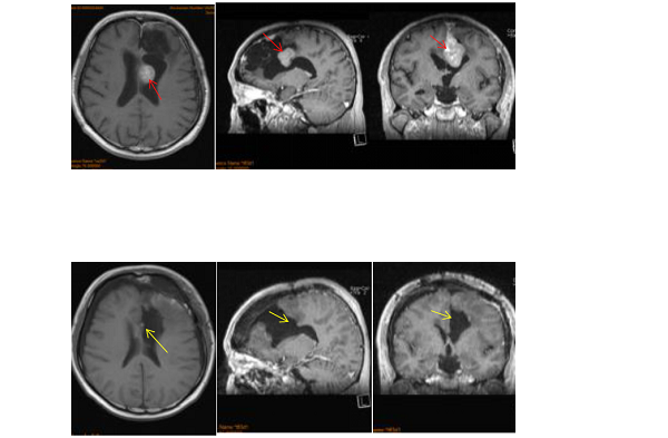 什么是多发脑膜瘤?是恶性的么？