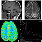 脑胶质瘤有哪些保守治疗方法？脑胶质瘤可以不做手术吗？