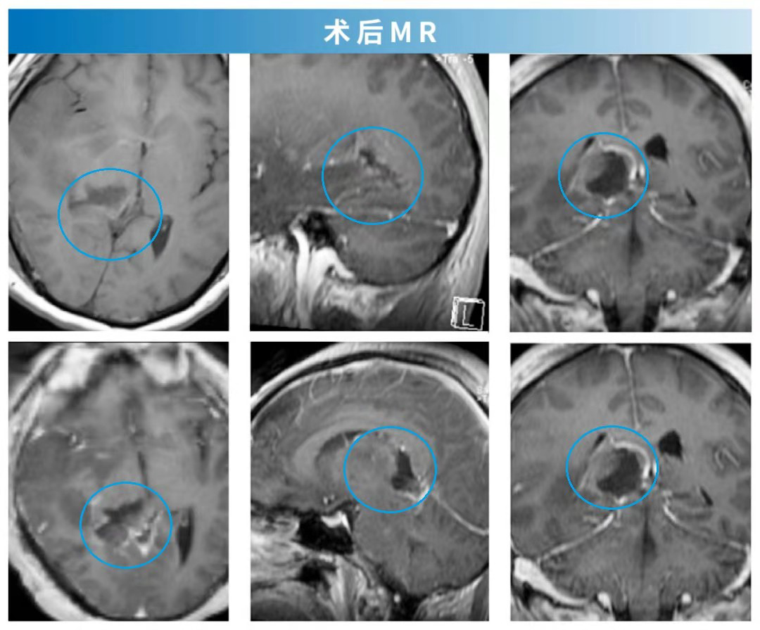 贺晓生教授高度恶性脑胶质瘤的手术切除案例_患者