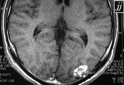 偶发脑海绵状血管瘤需要手术吗？