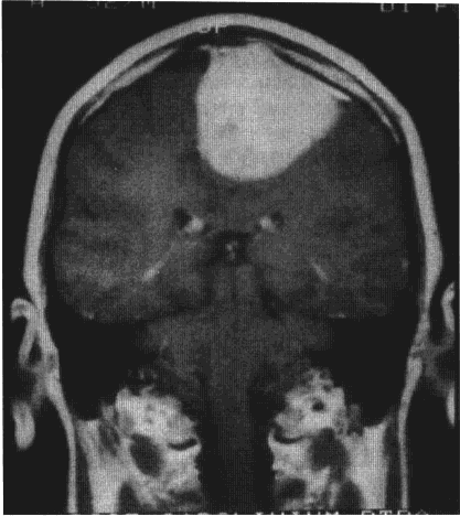 矢状窦旁脑膜瘤的特点和手术治疗