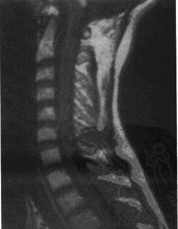 中枢神经系统血管母细胞瘤症状有哪些？怎么治？