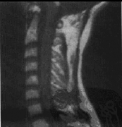 中枢神经系统血管母细胞瘤症状有哪些？怎么治？