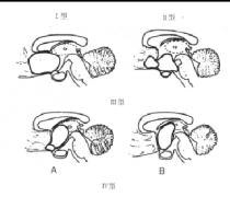 下丘脑胶质瘤需要手术吗？