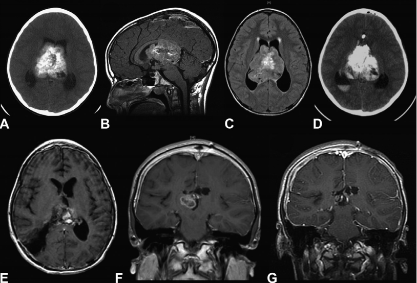 室管膜瘤手术治疗案例