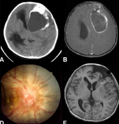 INC国际专家较大室管膜瘤手术、放疗综合治疗病例交流