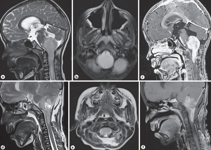 脊髓胶质瘤能治好吗？