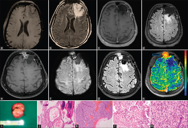 额叶少枝胶质瘤怎么治