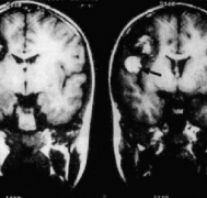 脑海绵状血管瘤症状有哪些？