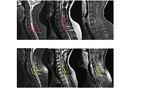 脊髓胶质瘤能治好吗？